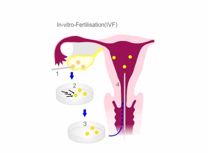 In-vitro Fertilisation