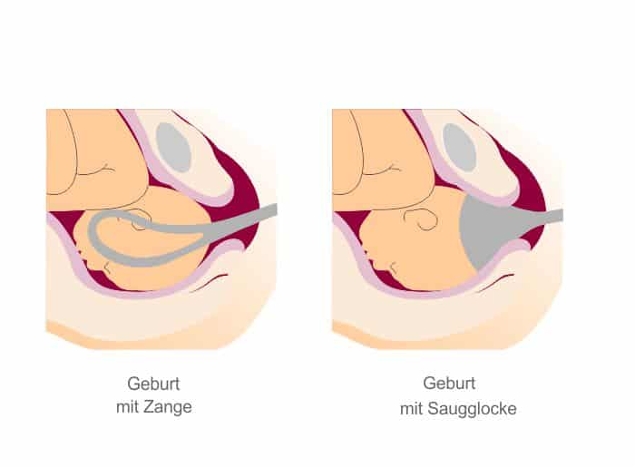 Zange und Saugglocke