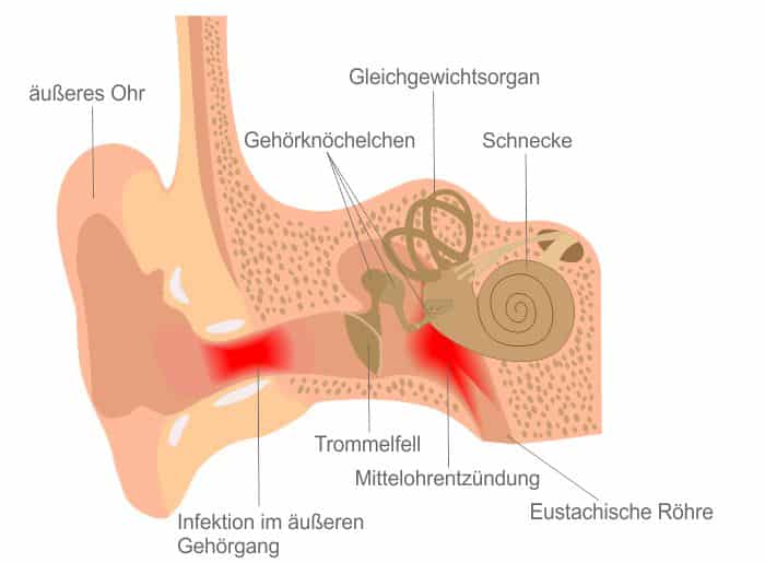 Mittelohrentzündung